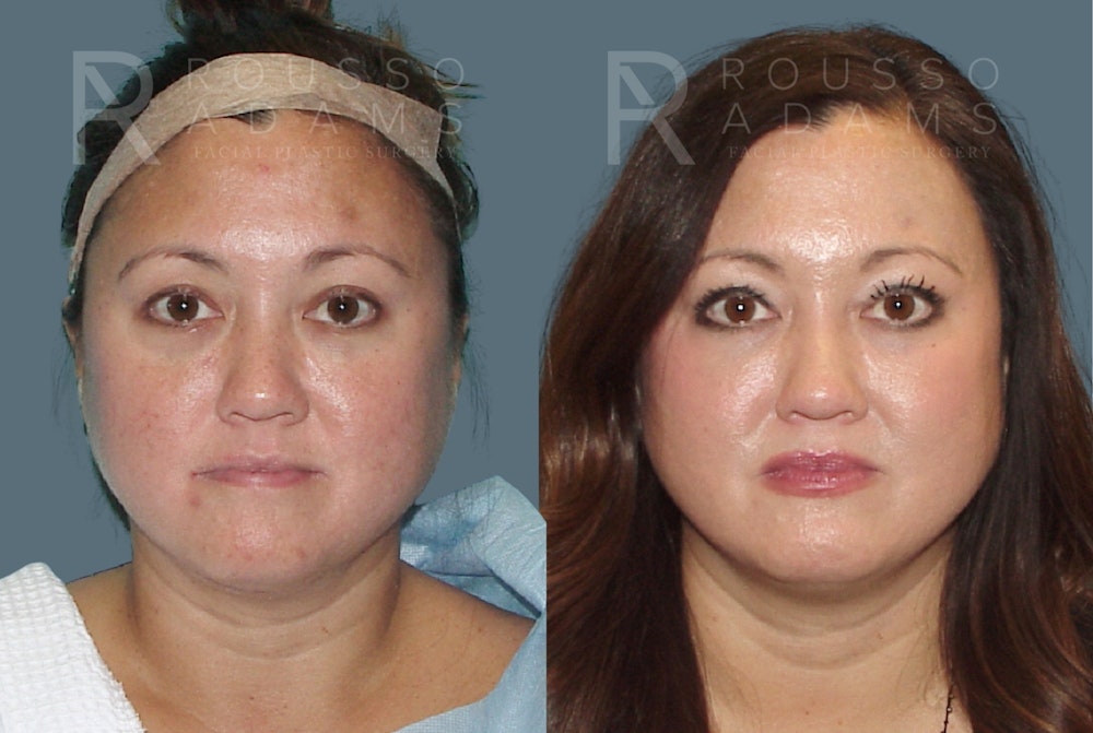 Plasma Skin Resurfacing <span class=small>By Dr. Daniel Rousso</span> Before & After Gallery - Patient 417851 - Image 3