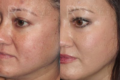 Plasma Skin Resurfacing <span class=small>By Dr. Daniel Rousso</span> Before & After Gallery - Patient 417851 - Image 2