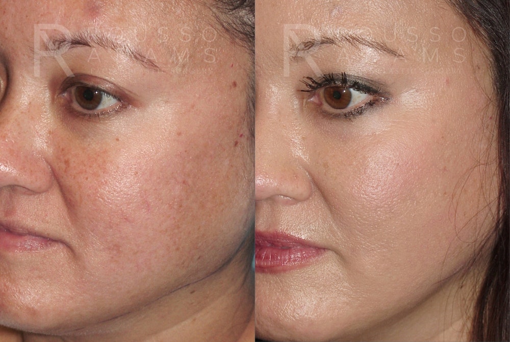Plasma Skin Resurfacing <span class=small>By Dr. Daniel Rousso</span> Before & After Gallery - Patient 417851 - Image 2