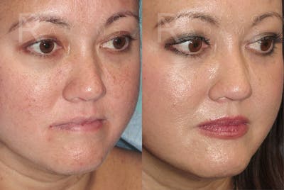 Plasma Skin Resurfacing <span class=small>By Dr. Daniel Rousso</span> Before & After Gallery - Patient 417851 - Image 1