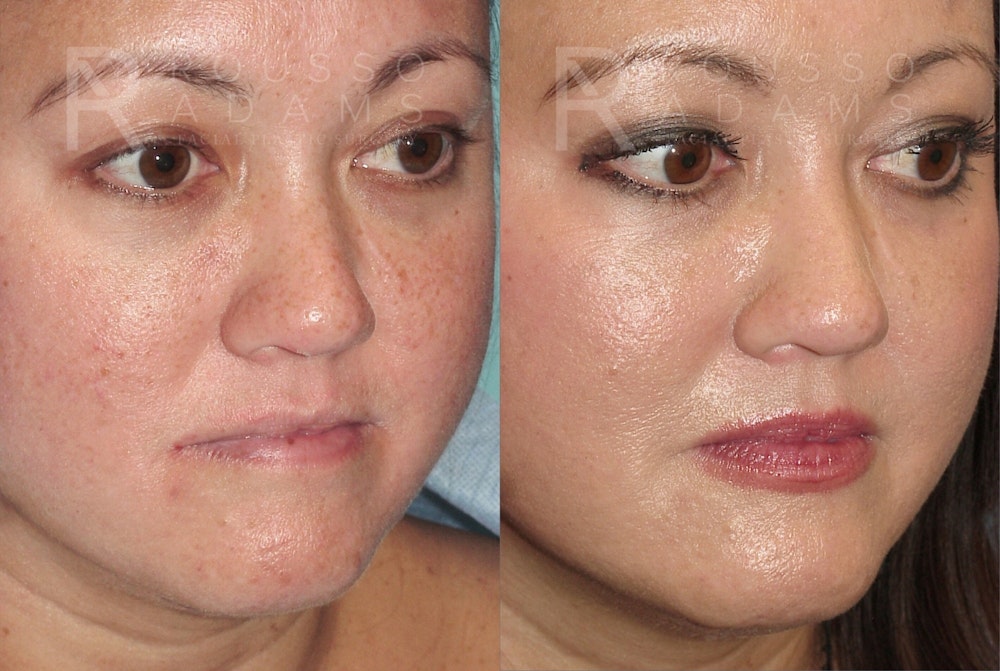 Plasma Skin Resurfacing <span class=small>By Dr. Daniel Rousso</span> Before & After Gallery - Patient 417851 - Image 1