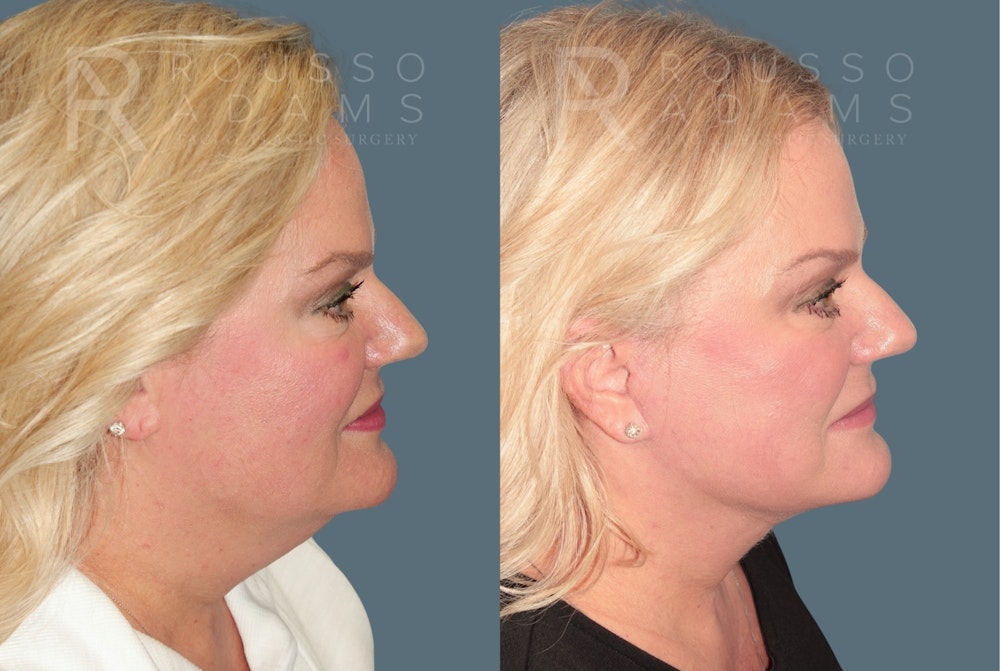 Deep Plane Facelift <span class=small>By Dr. Daniel Rousso</span> Before & After Gallery - Patient 384678 - Image 3