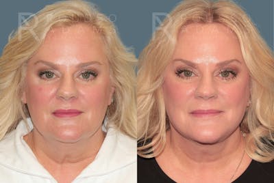 Deep Plane Facelift <span class=small>By Dr. Daniel Rousso</span> Before & After Gallery - Patient 384678 - Image 2