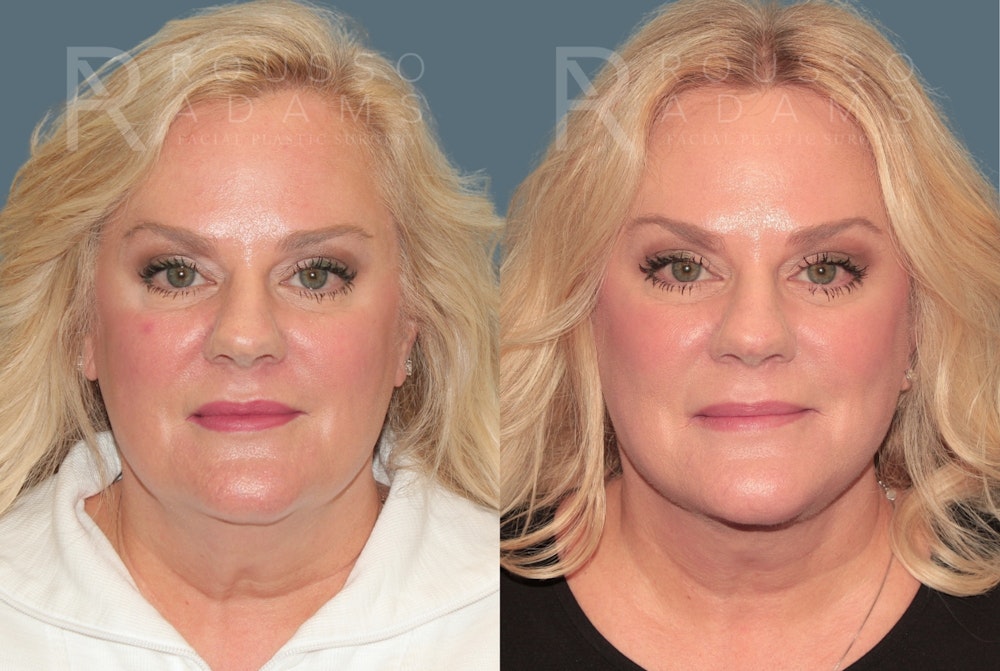 Deep Plane Facelift <span class=small>By Dr. Daniel Rousso</span> Before & After Gallery - Patient 384678 - Image 2