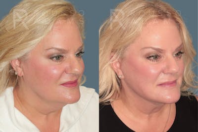 Deep Plane Facelift <span class=small>By Dr. Daniel Rousso</span> Before & After Gallery - Patient 384678 - Image 1