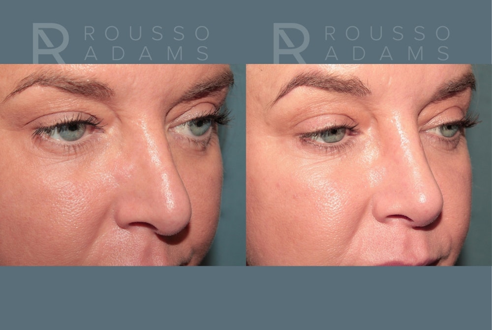 Revision Rhinoplasty <span class=small>By Dr. Daniel Rousso</span> Before & After Gallery - Patient 329113 - Image 3