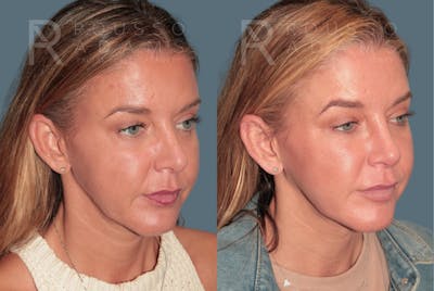 Revision Rhinoplasty <span class=small>By Dr. Daniel Rousso</span> Before & After Gallery - Patient 329113 - Image 1