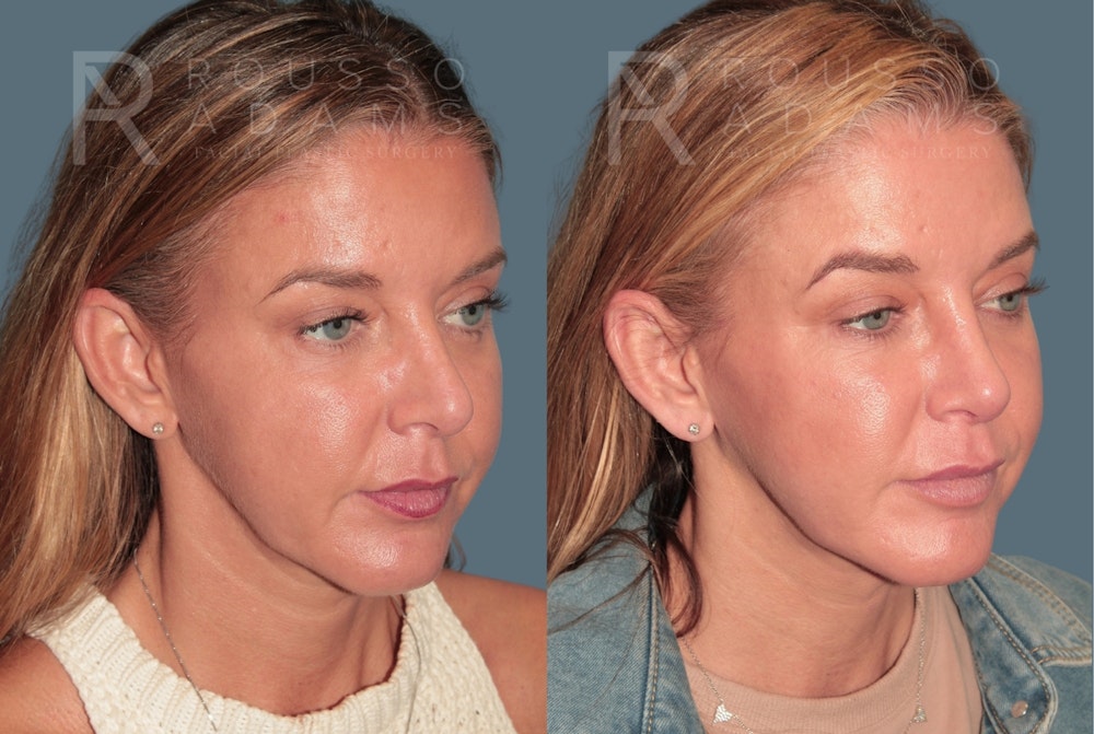 Revision Rhinoplasty <span class=small>By Dr. Daniel Rousso</span> Before & After Gallery - Patient 329113 - Image 1