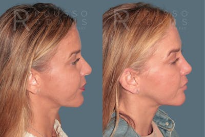 Revision Rhinoplasty <span class=small>By Dr. Daniel Rousso</span> Before & After Gallery - Patient 329113 - Image 2
