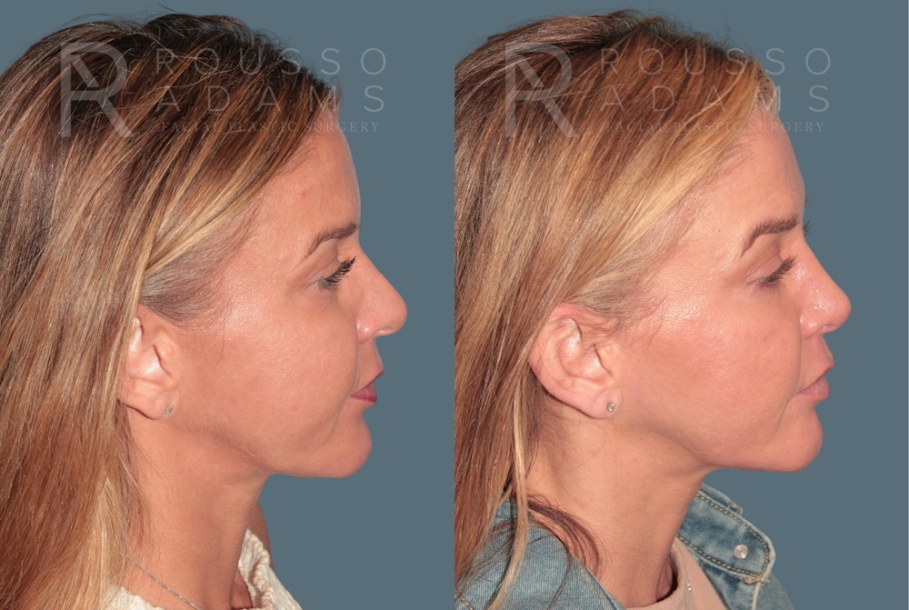 Revision Rhinoplasty <span class=small>By Dr. Daniel Rousso</span> Before & After Gallery - Patient 329113 - Image 2