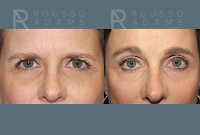 SculptLift™ <span class=small>By Dr. Daniel Rousso</span> Before & After Gallery - Patient 413879 - Image 4