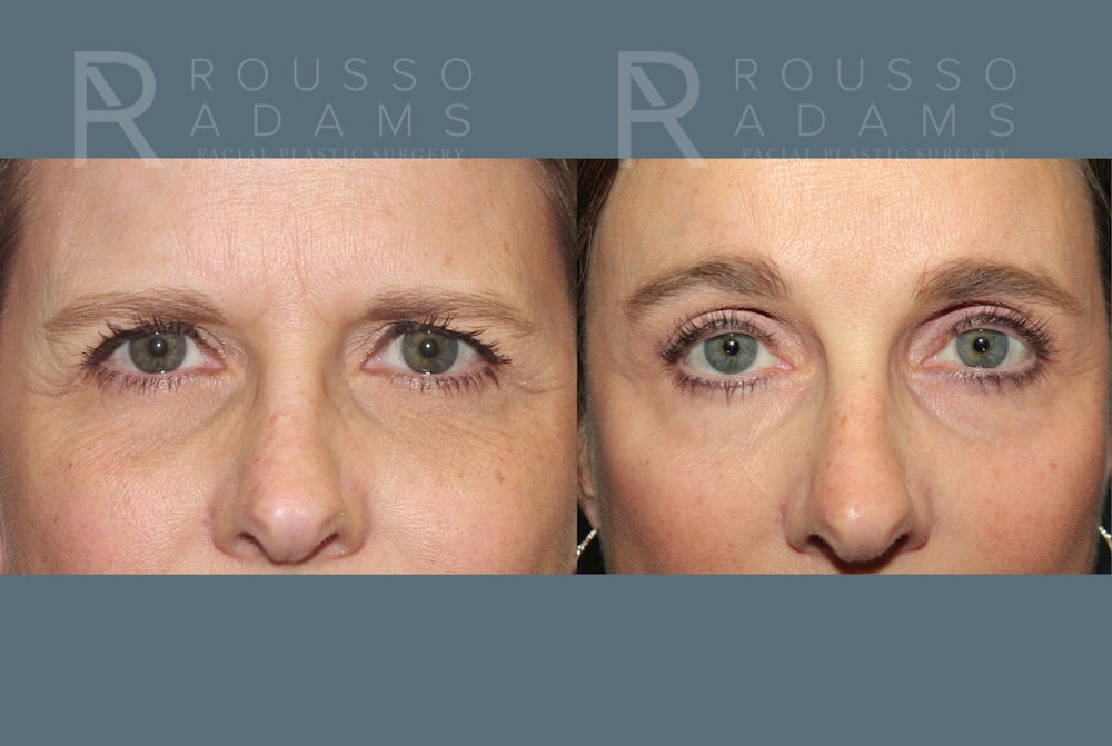 SculptLift™ <span class=small>By Dr. Daniel Rousso</span> Before & After Gallery - Patient 413879 - Image 4