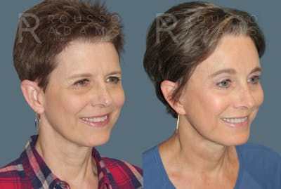 SculptLift™ <span class=small>By Dr. Daniel Rousso</span> Before & After Gallery - Patient 413879 - Image 1