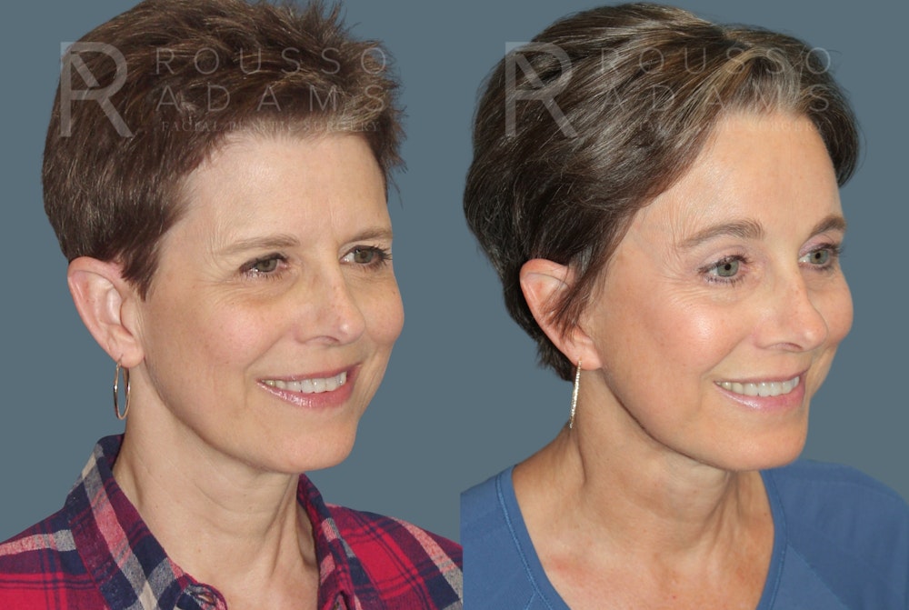 SculptLift™ <span class=small>By Dr. Daniel Rousso</span> Before & After Gallery - Patient 413879 - Image 1