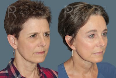 SculptLift™ <span class=small>By Dr. Daniel Rousso</span> Before & After Gallery - Patient 413879 - Image 2