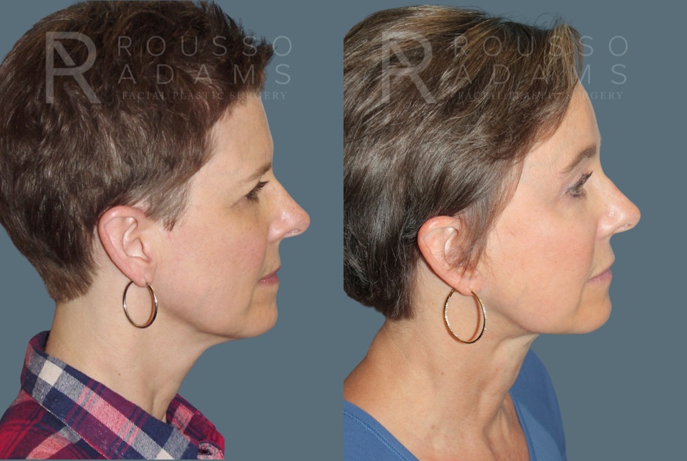 SculptLift™ <span class=small>By Dr. Daniel Rousso</span> Before & After Gallery - Patient 413879 - Image 3