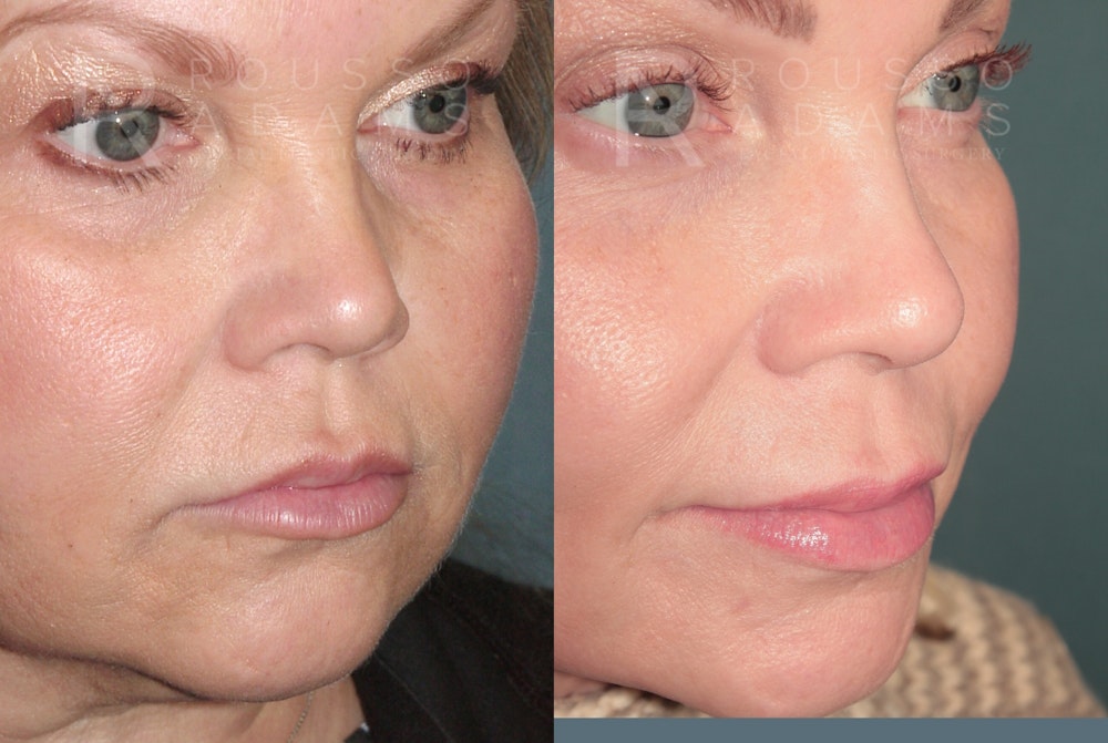 SculptLift™ <span class=small>By Dr. Daniel Rousso</span> Before & After Gallery - Patient 402166 - Image 2