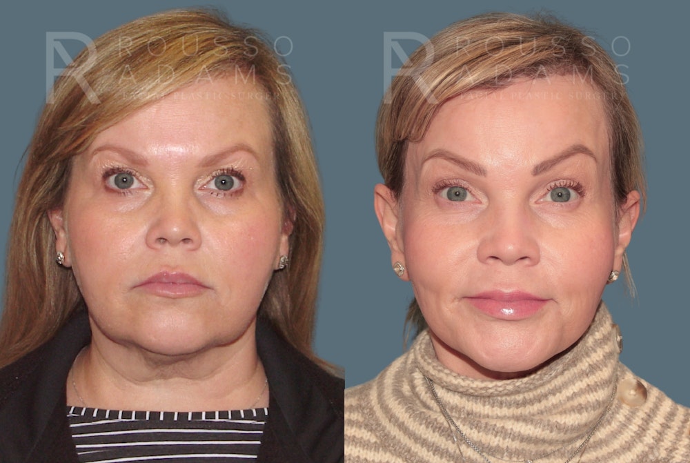 SculptLift™ <span class=small>By Dr. Daniel Rousso</span> Before & After Gallery - Patient 402166 - Image 3