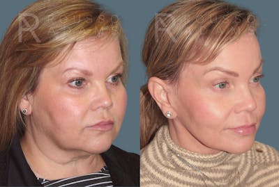 SculptLift™ <span class=small>By Dr. Daniel Rousso</span> Before & After Gallery - Patient 402166 - Image 1