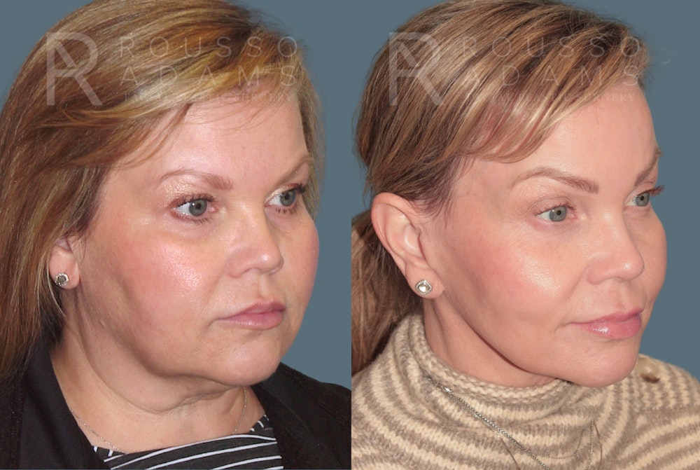SculptLift™ <span class=small>By Dr. Daniel Rousso</span> Before & After Gallery - Patient 402166 - Image 1
