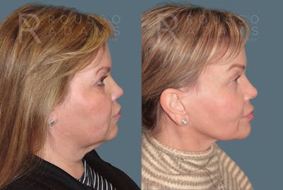 SculptLift™ <span class=small>By Dr. Daniel Rousso</span> Before & After Gallery - Patient 402166 - Image 4