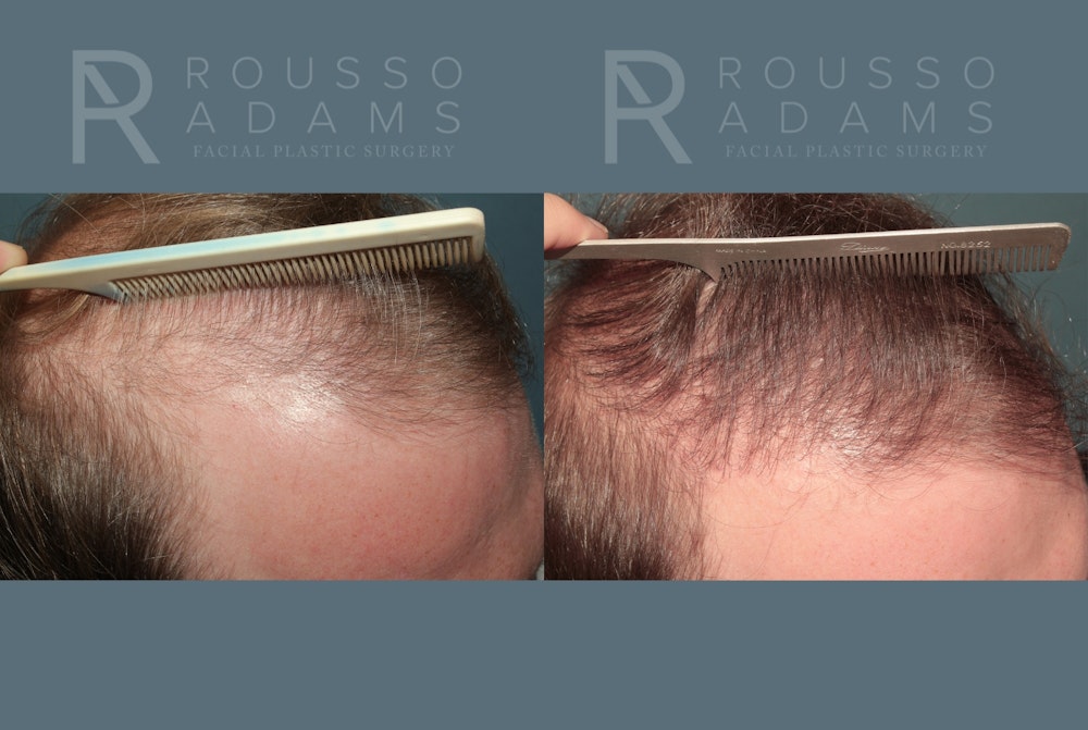 Hair Transplant Before & After Gallery - Patient 369979 - Image 1