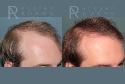 Hair Transplant Before & After Gallery - Patient 369979 - Image 2