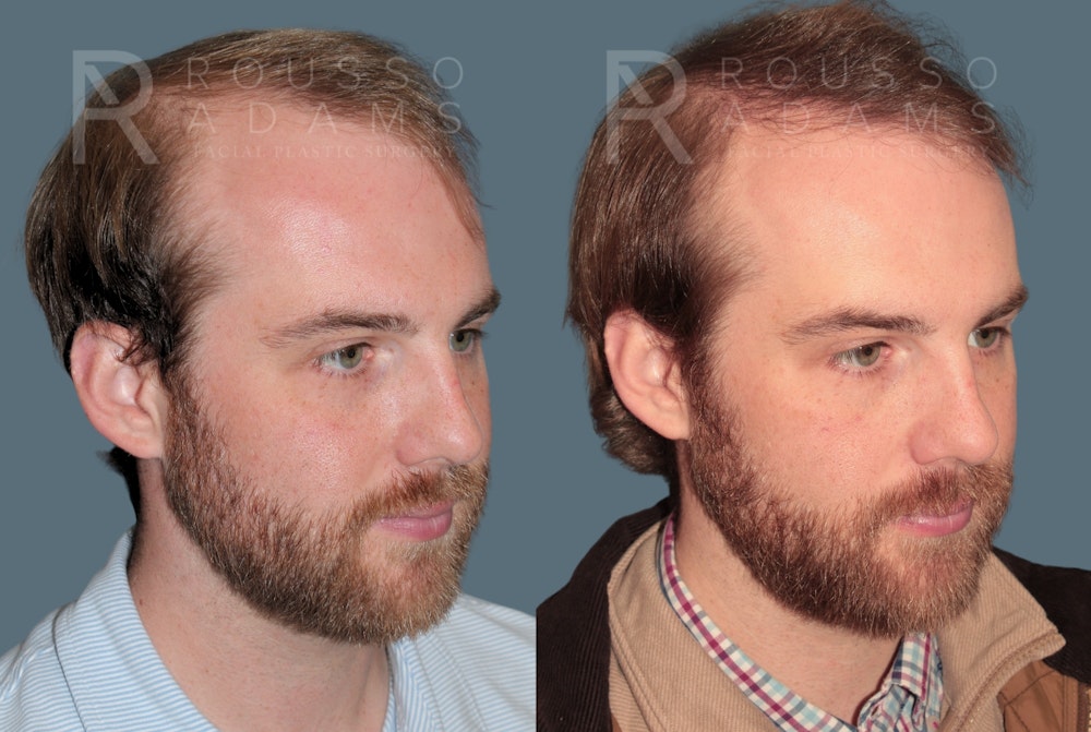 Hair Transplant Before & After Gallery - Patient 369979 - Image 5