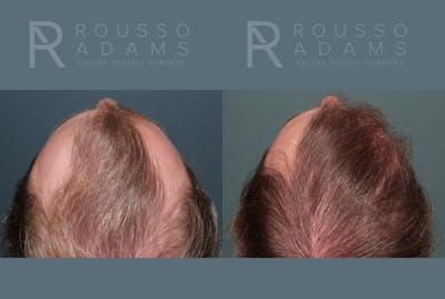 Hair Transplant Before & After Gallery - Patient 369979 - Image 4