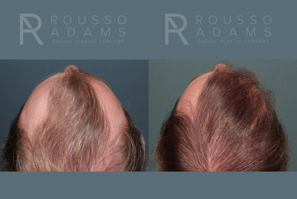 Hair Transplant Before & After Gallery - Patient 369979 - Image 4