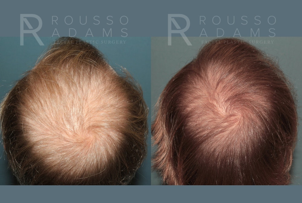 Hair Transplant Before & After Gallery - Patient 369979 - Image 3