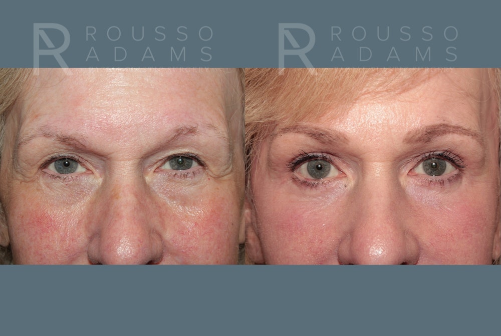 Deep Plane Facelift <span class=small>By Dr. Daniel Rousso</span> Before & After Gallery - Patient 318882 - Image 5