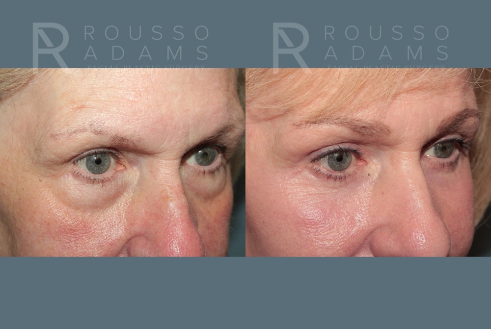 Deep Plane Facelift <span class=small>By Dr. Daniel Rousso</span> Before & After Gallery - Patient 318882 - Image 4