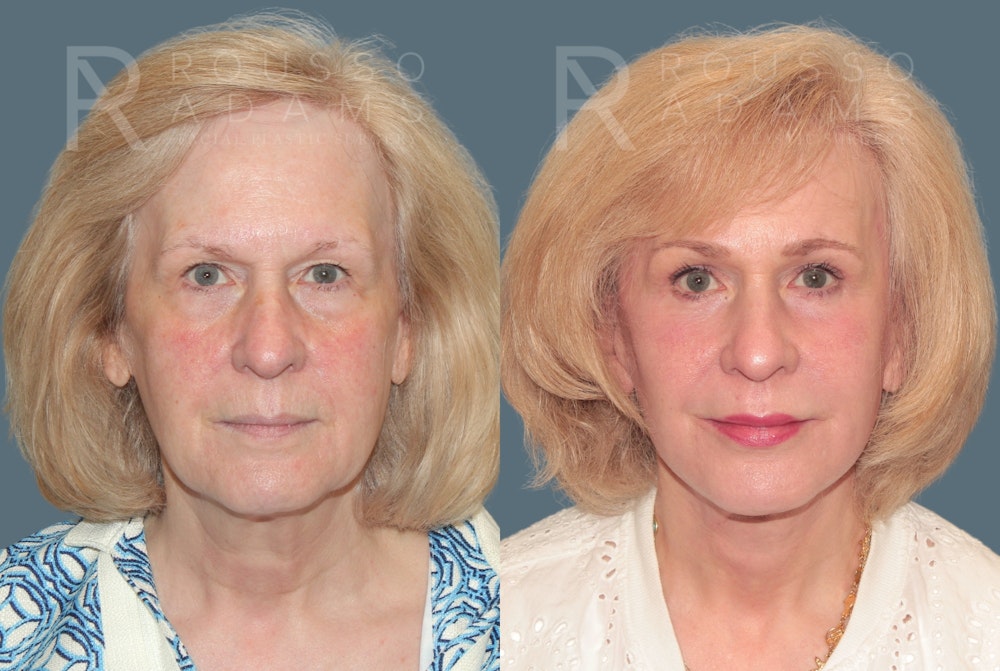 Deep Plane Facelift <span class=small>By Dr. Daniel Rousso</span> Before & After Gallery - Patient 318882 - Image 3