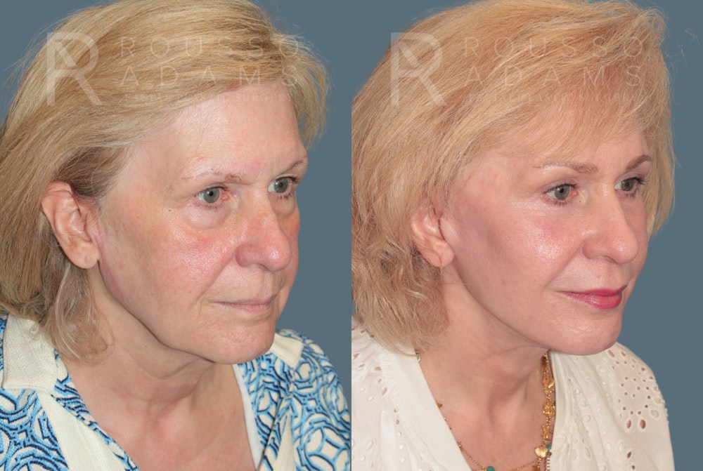 Deep Plane Facelift <span class=small>By Dr. Daniel Rousso</span> Before & After Gallery - Patient 318882 - Image 1
