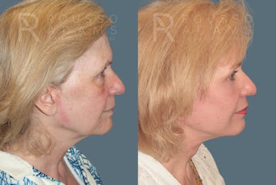 Deep Plane Facelift <span class=small>By Dr. Daniel Rousso</span> Before & After Gallery - Patient 318882 - Image 2