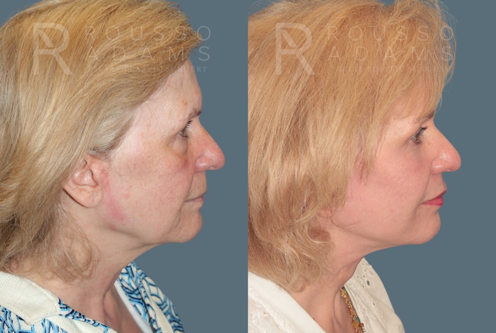 Deep Plane Facelift <span class=small>By Dr. Daniel Rousso</span> Before & After Gallery - Patient 318882 - Image 2