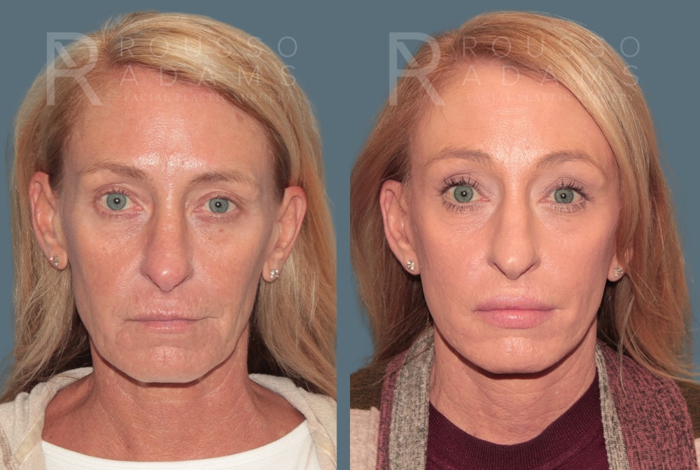 Deep Plane Facelift <span class=small>By Dr. Daniel Rousso</span> Before & After Gallery - Patient 171526 - Image 3