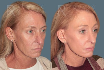 Deep Plane Facelift <span class=small>By Dr. Daniel Rousso</span> Before & After Gallery - Patient 171526 - Image 1