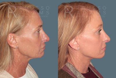 Deep Plane Facelift <span class=small>By Dr. Daniel Rousso</span> Before & After Gallery - Patient 171526 - Image 2