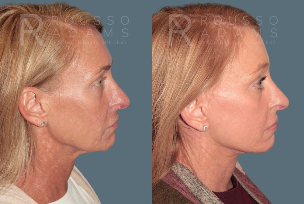 Deep Plane Facelift <span class=small>By Dr. Daniel Rousso</span> Before & After Gallery - Patient 171526 - Image 2