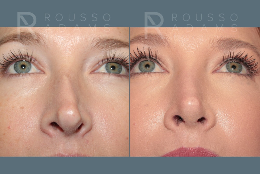 Rhinoplasty <span class=small>By Dr. Daniel Rousso</span> Before & After Gallery - Patient 302919 - Image 5