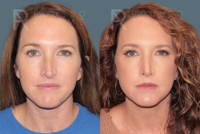 Rhinoplasty <span class=small>By Dr. Daniel Rousso</span> Before & After Gallery - Patient 302919 - Image 4