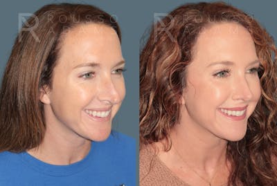 Revision Rhinoplasty <span class=small>By Dr. Daniel Rousso</span> Before & After Gallery - Patient 122084 - Image 2