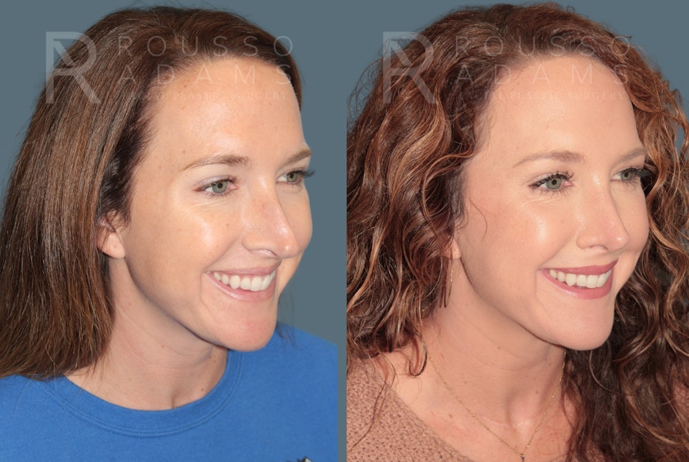 Rhinoplasty <span class=small>By Dr. Daniel Rousso</span> Before & After Gallery - Patient 302919 - Image 3