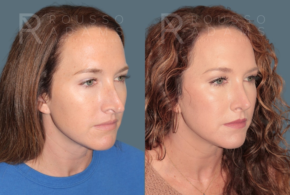 Rhinoplasty <span class=small>By Dr. Daniel Rousso</span> Before & After Gallery - Patient 302919 - Image 2