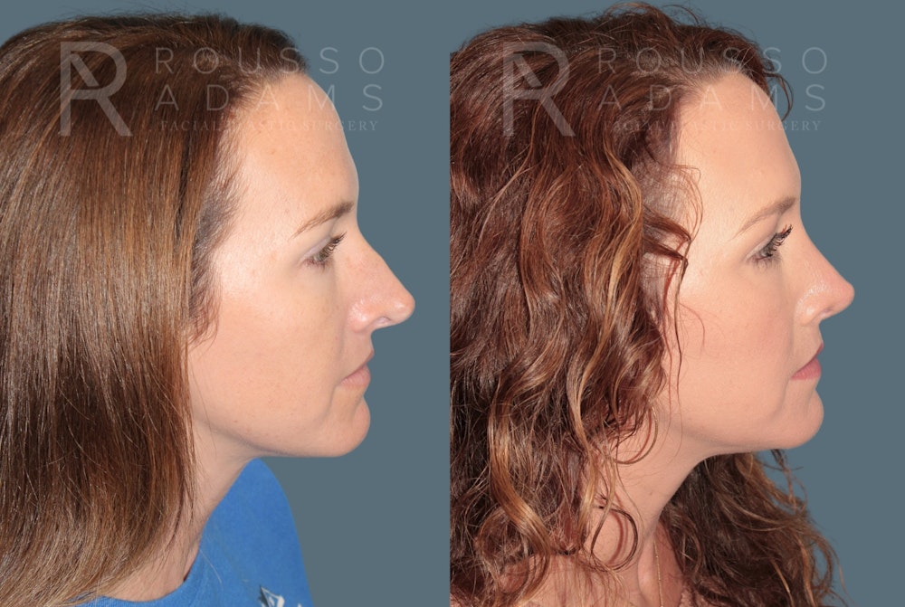 Rhinoplasty <span class=small>By Dr. Daniel Rousso</span> Before & After Gallery - Patient 302919 - Image 1