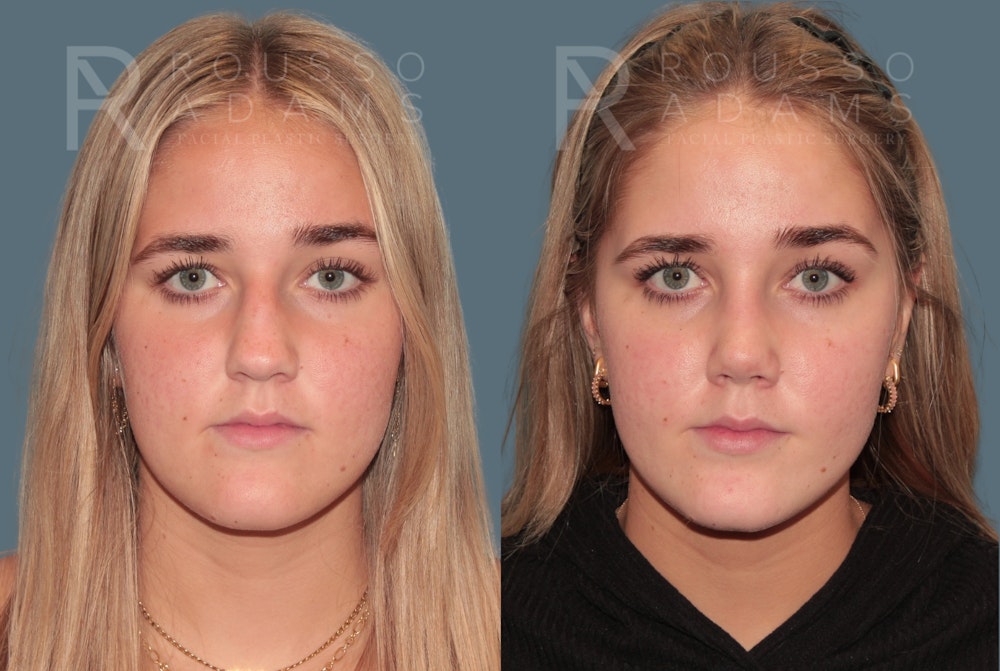 Rhinoplasty <span class=small>By Dr. Daniel Rousso</span> Before & After Gallery - Patient 332828 - Image 3