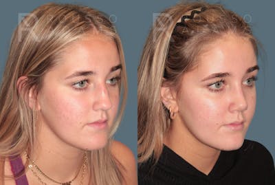 Rhinoplasty <span class=small>By Dr. Daniel Rousso</span> Before & After Gallery - Patient 332828 - Image 2
