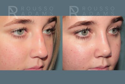 Rhinoplasty <span class=small>By Dr. Daniel Rousso</span> Before & After Gallery - Patient 332828 - Image 4